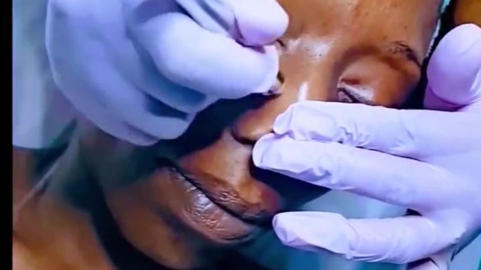 Microdermabrasion